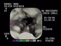 CANDIDIASIS ESOFAGICA SEVERA