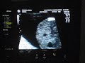 Fernadas - Ultra sound video - UCA 2008 - Part 3