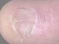 Nail Lichen Planus
