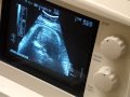 Babyscan678