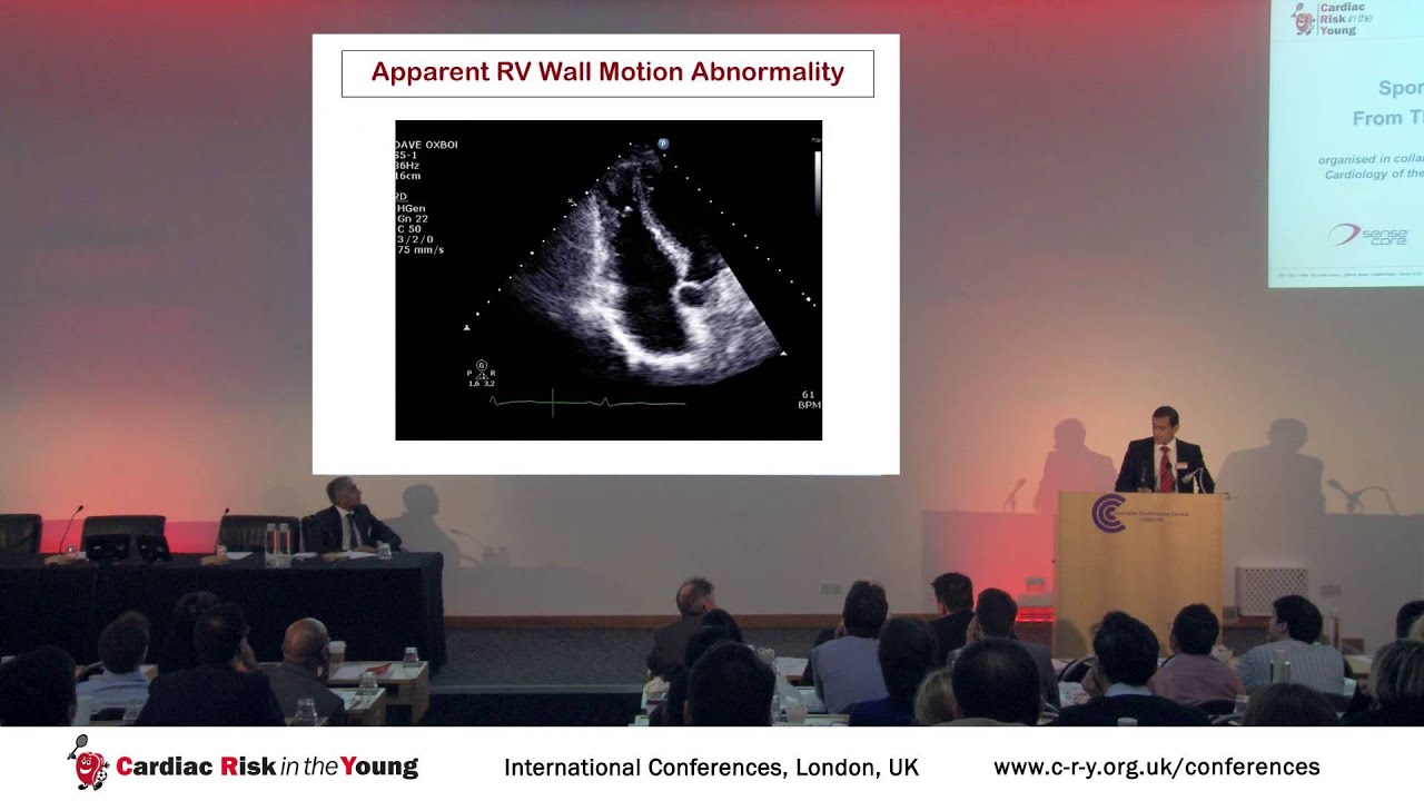 Right Ventricular Enlargement in athletes; Physiology vs pathology