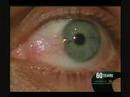 how to cure pterygium naturally