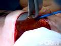 Nipple Sparing Mastectomy with Reconstruction