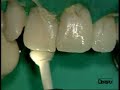 Dentsply - Pogo One step diamond micro-polisher