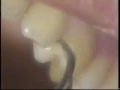 micro ultrasonic teeth cleaning micro ultrasonic teeth cleaning