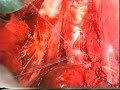 Introverting Broncoplasty after wedge Resection