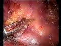 Appendicectomia (appendicitis) laparoscopica con dissettore ad ultrasuoni. Appendicectomia (appendicitis) laparoscopica con dissettore ad ultrasuoni.
