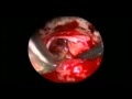 Adenoma Of Hypophysis, Endonasal Endoscopy Adenoma Of Hypophysis, Endonasal Endoscopy
