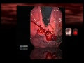 Esophago Gastric Varices