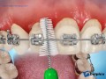 Brushing Braces with Proxabrush (Poor Hygiene)