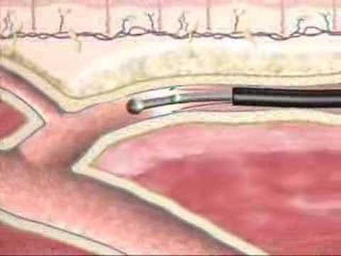 Varicose Veins Closure Procedure at ...