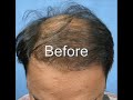Danish - 3500 FUHT grafts (1 year update) Dr. A's Clinic
