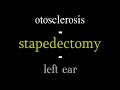 stapedectomy - Dr. Bliouras Konstantinos