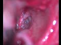 stapedectomy - Dr. Bliouras Konstantinos
