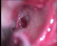 stapedectomy - Dr. Bliouras Konstantinos