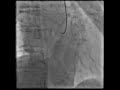 慢性完全閉塞（CTO）13 Ischemic Heart Disease