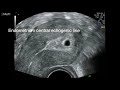 ultrasound appearances of a pregnancy at 5 weeks gestation