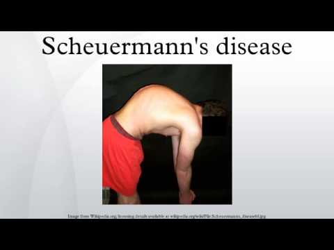 how to cure scheuermann's kyphosis