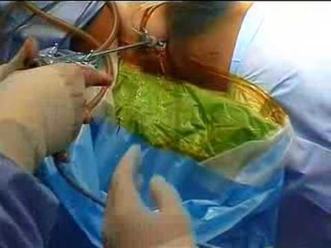 Endoscopic Discectomy