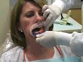 Prelimiary impression technique for a diagnostic wax-up