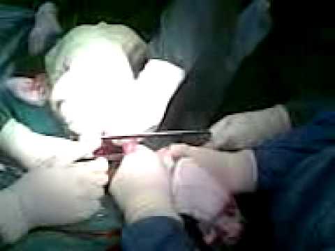 amputacion - Paciente de 60 años, diabetico, el cual presento una fractura en la cabeza del femur. se implanto una protesis del mismo. la implantacion no fue exitosa debi...