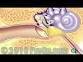 Myringotomy Insertion of Tube PreOp® Patient Education Feature