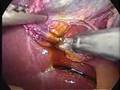 cholecystectomy cholecystectomy