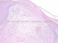 Chondrodermatitis Nodularis Helicis