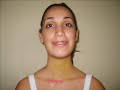 Cirurgia Ortognática - renascimento Cirurgia Ortognática - renascimento