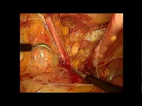 hernioplastia - descripcion de la realizacion de una hernioplastia inguinal directa con malla por laparoscopia. www.obesidadylaparoscopia.com.