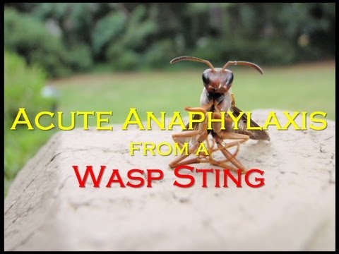 how to relieve wasp sting