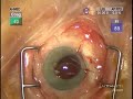 Scleral suture fixation of inbag PCIOL