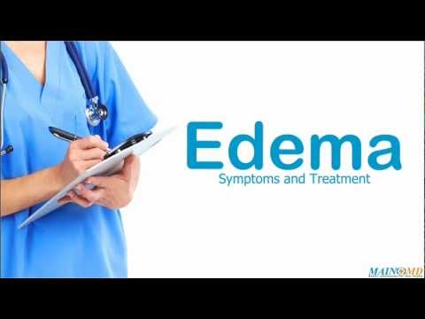 how to relieve edema