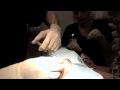 Facial  Removal