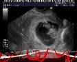 3 mes�s de gravidez