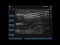 Ultrasound-Guided Femoral Nerve Block Ultrasound-Guided Femoral Nerve Block