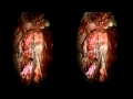 Resection of an anterior spinal cord AVM through a far-lateral approach (3D)