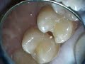 Class II HyperFluendce Erbium Prep