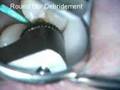 Class II HyperFluendce Erbium Prep