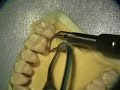 Perioscopy Explorer Positioning UL Palatal