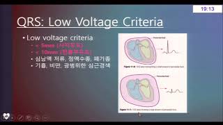 Hospital basic - Drug induced abnormal ECG - 삼척의료원 김윤성 선생님