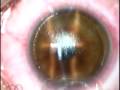 Cirurgia Laser de Miopia