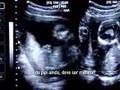 18 WEEKS PREGNANCY