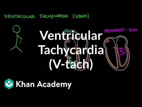 how to treat vtach