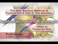 Lumbar Disc Prolapse Animation Lumbar Disc Prolapse Animation