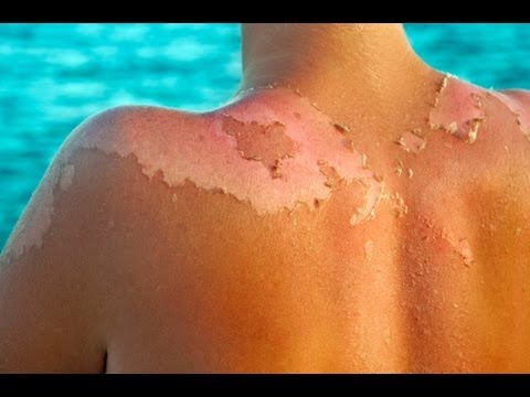 how to cure sunburn face