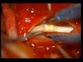 tethered spinal cord