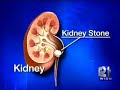 Children Getting Kidney Stones More Often, Doctors Say