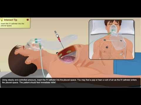 how to relieve tension pneumothorax