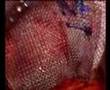Laparoscopic extraperitoneal repair of strangulated femoral